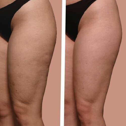 Bacak İnceltme Selülit Giderme, Ödem Atma, Sıkılaştırma Masaj Aleti