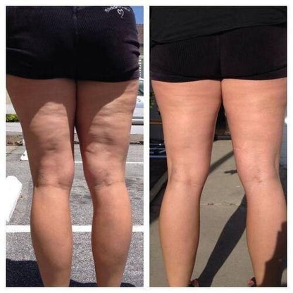 Bacak İnceltme Selülit Giderme, Ödem Atma, Sıkılaştırma Masaj Aleti